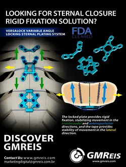 FDA Approved GMReis Versalock System: Sternal Closure with Reduced Pain | Populer Platform