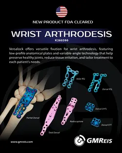 FDA Approved GMReis Wrist Fusion Solutions: Comprehensive Arthrodesis Systems | Populer Platform