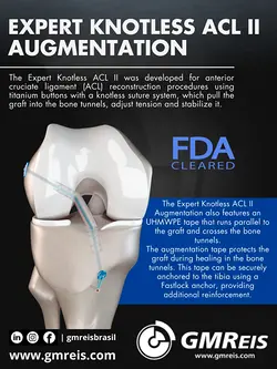 Innovative ACL Reconstruction: Expert ACL II Augmentation System Unveiled | Populer Platform