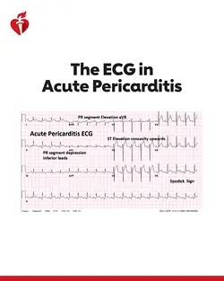 Mastering Acute Pericarditis: Insights from the American Heart Association | Populer Platform