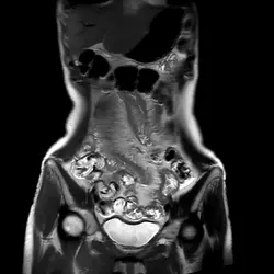 Understanding the Comb Sign in Mesenteric Vessels: MR LIVE Case Series Chapter 10 | Populer Platform